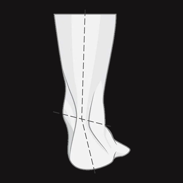 Overpronation illustration. 